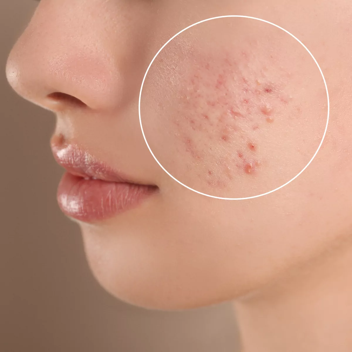acne close up