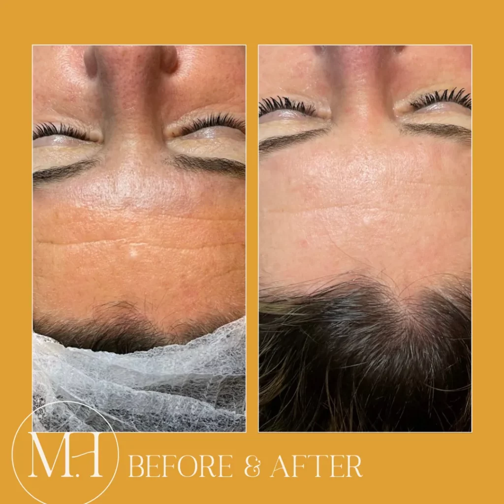 Voor en na foto van een microneedling behandeling